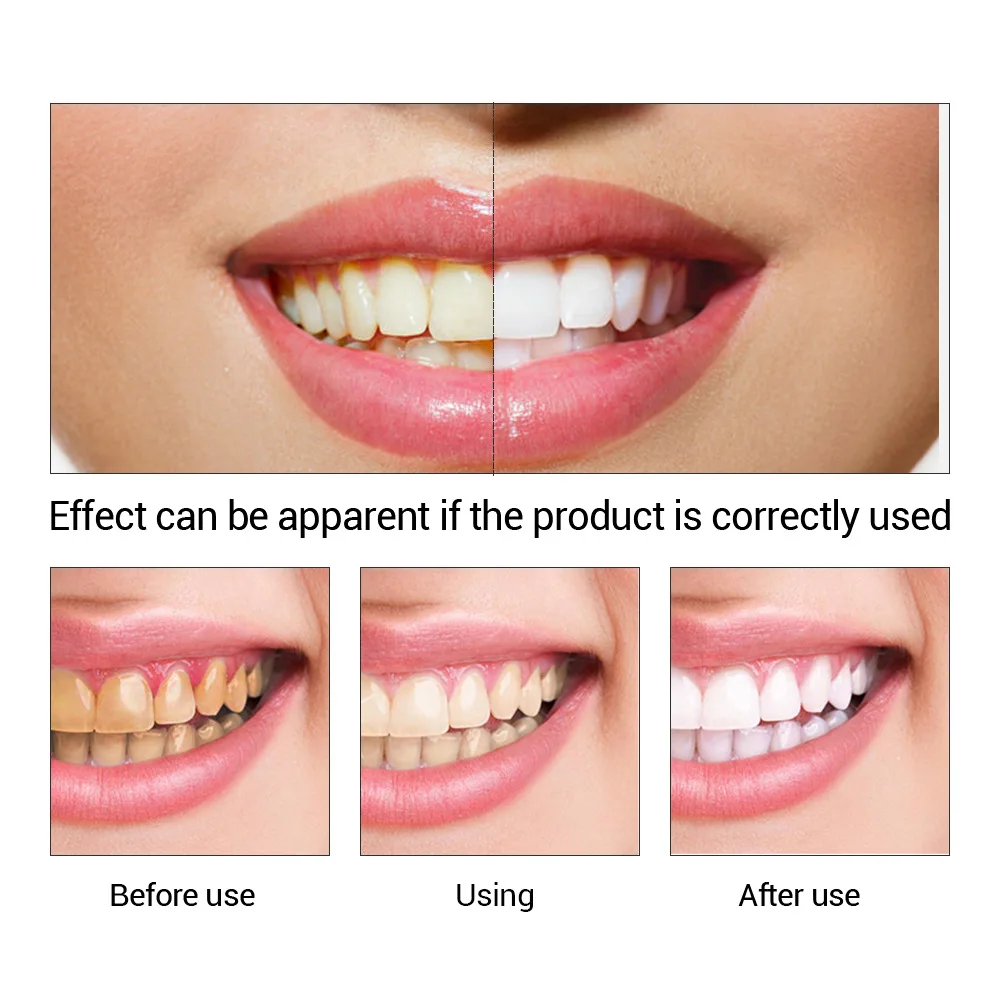 FTEENPLY Teeth Whitening Essen - Teeth Whitening Price 评论和价格