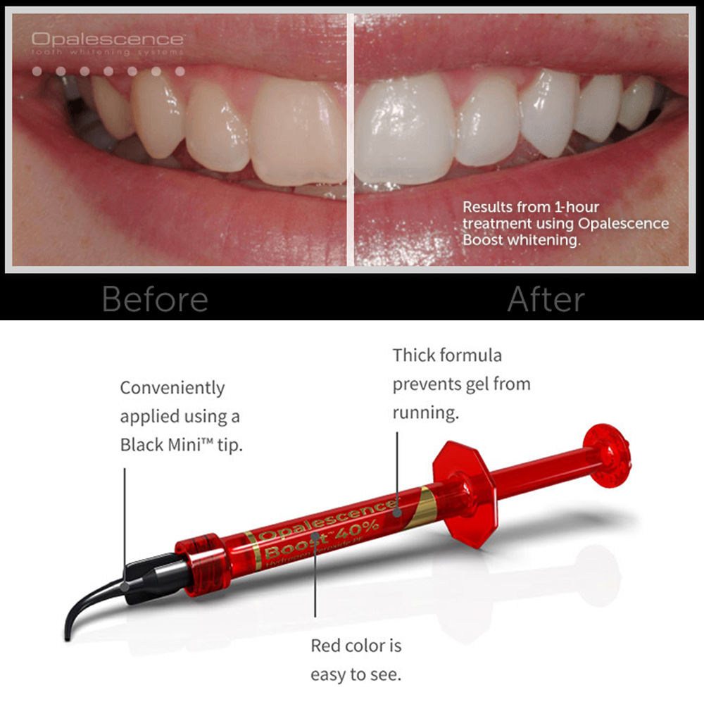 Ultradent Opalescence Boost PF - Teeth Whitening Opalescence 评论和价格